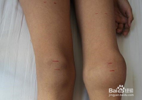 血友病有什么病症，会遗传吗？