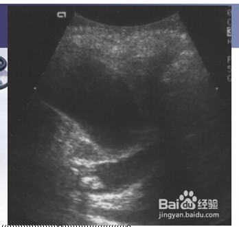 胆道系统几种常见疾病的影像图片。