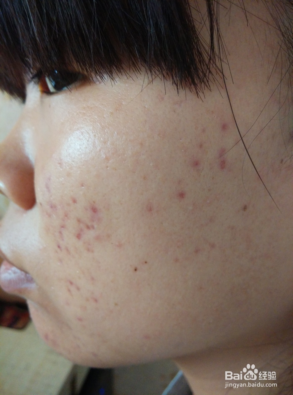 如果更好的祛痘