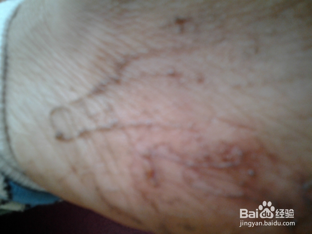 香蕉皮巧治皲裂