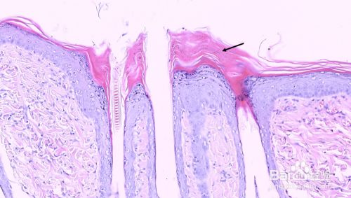 银屑病皮肤病理观察(baker评分)