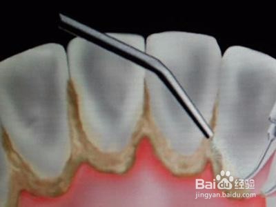 怎么知道有牙石