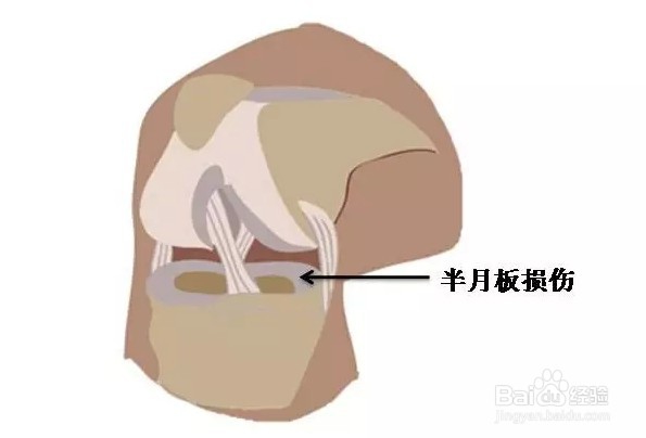 膝盖半月板损伤症状的三个应对办法