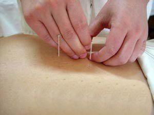 针灸减肥的方法与技巧