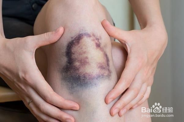 用自然疗法减轻血肿