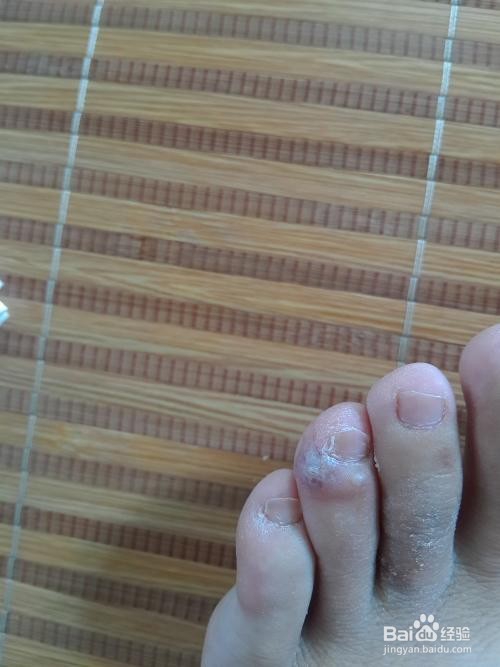 夏天脚上长水泡怎么办？