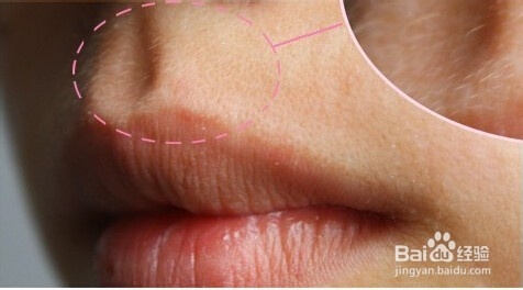 唇毛怎么去除?唇毛可以永久去除吗?