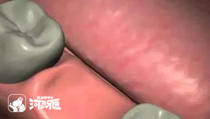几张图让你看明白种植牙的过程！