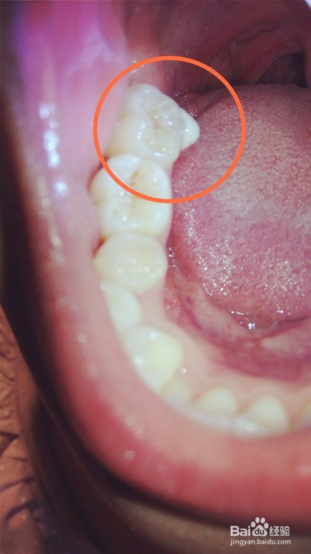 缓解牙齿正畸舌侧扣刮舌疼痛经验