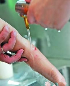 不小心擦伤怎么办