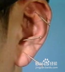 针灸减肥方法有哪些