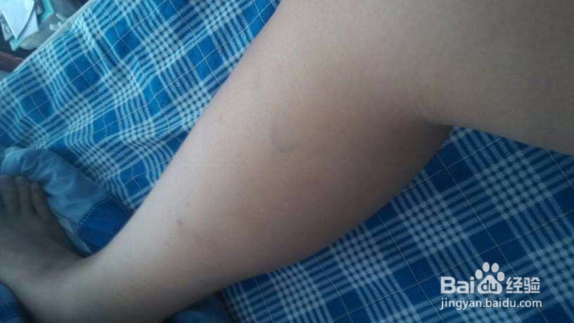 静脉曲张的早期症状都有哪些，该怎么治