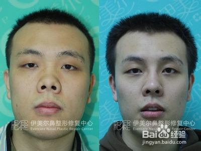 短鼻、朝天鼻 前后对比照片