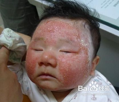 婴儿长湿疹怎么办