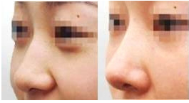 硅胶隆鼻手术痛不痛