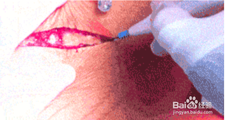 卡到鱼刺后千万要处理妥当