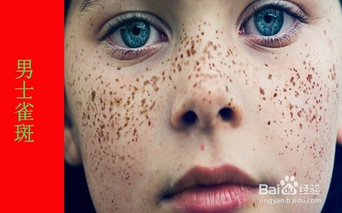 怎样调理男人脸上的斑/男性雀斑如何调理