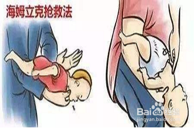 什么是海姆立克急救法