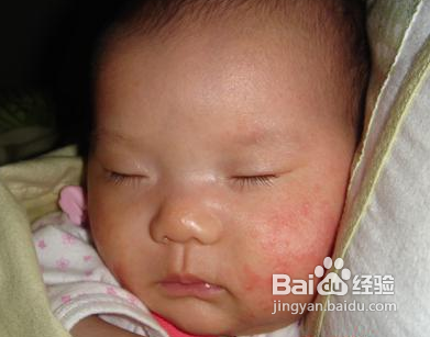 婴儿长湿疹怎么办