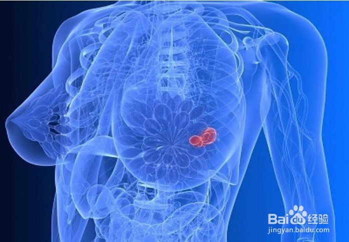 从乳腺增生到乳腺癌仅有四步,你知道吗