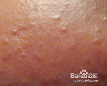 额头上长痘痘怎么治最近长了很多小包有些还红