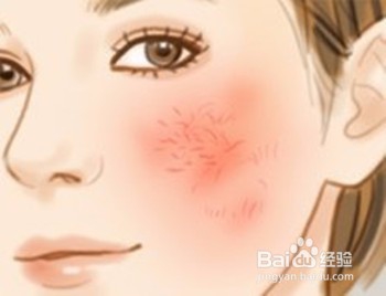 敏感肌肤换季时如何避免面部红血丝