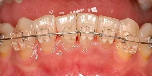 牙齿矫正期间的正确刷牙方法