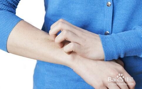 如何分辨湿疹和癣