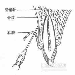 有蛀牙怎么办修补蛀牙什么是根管治疗