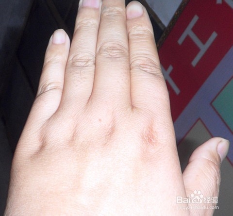 怎样判断你的体内是否有湿气