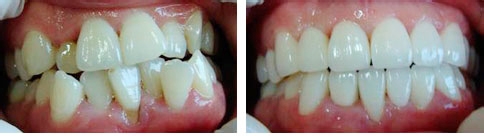 牙齿矫正的方法具体有哪几种
