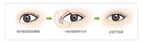 韩式整形：[4]如何做内眼角开大