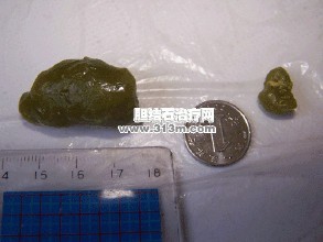 人体胆结石疾病如何分类