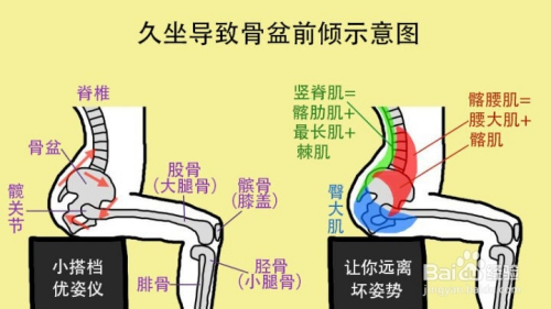 骨盆前倾原因 自测 危害 矫正是怎样的 百度经验