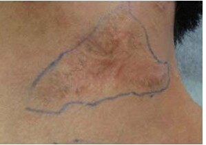 整形术后会不会有疤痕？