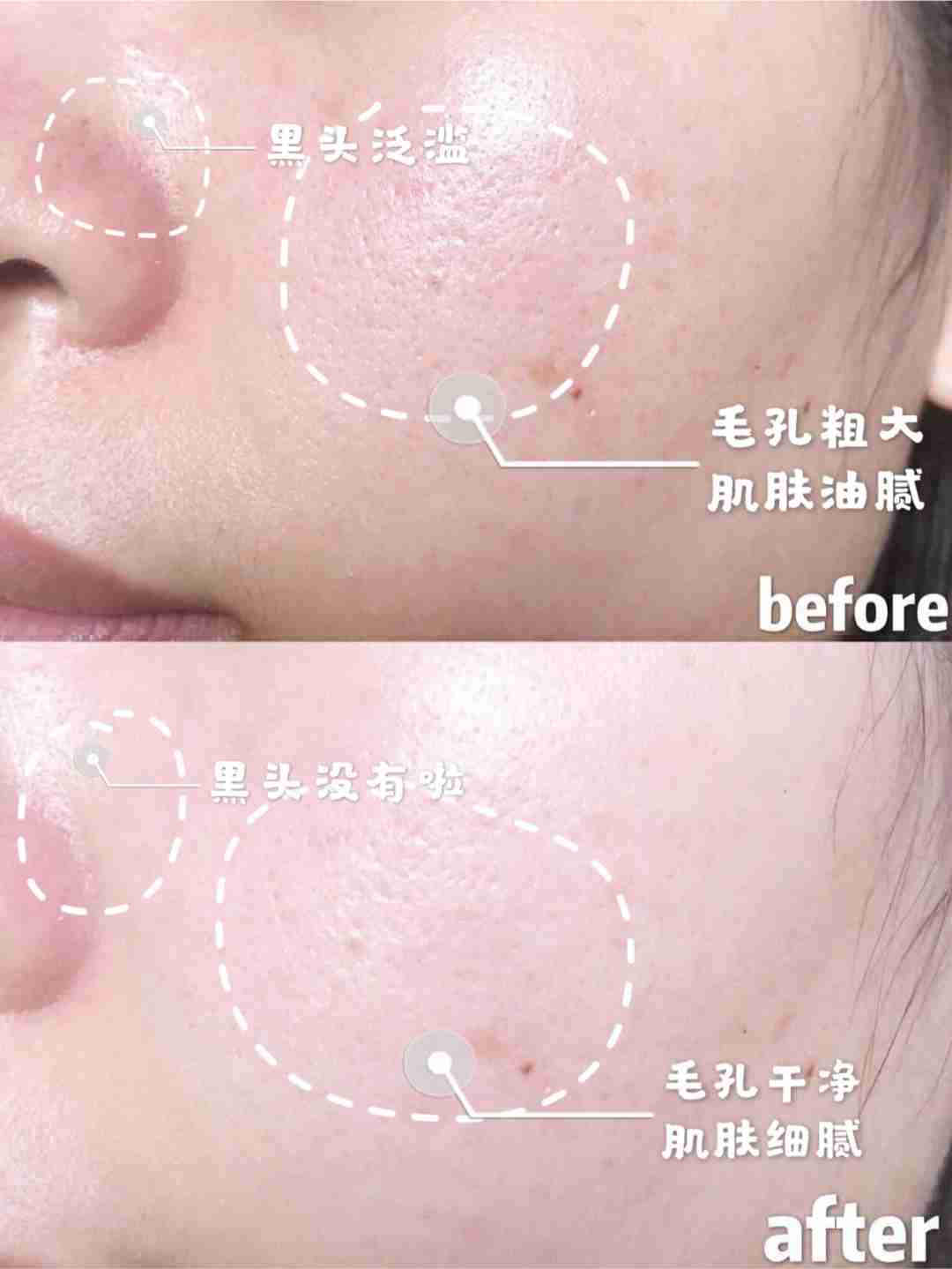 清洁不到位，护肤全白费，超好用的清洁面膜来啦