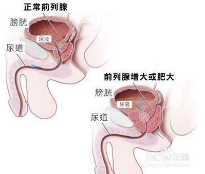 前列腺炎症状