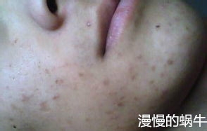 各种痘痘类型各种对应处理