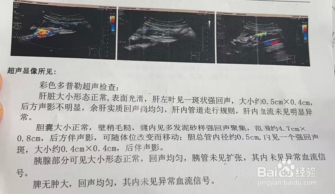 胆囊泥沙样结石，如何判断是否要进行切除胆囊？