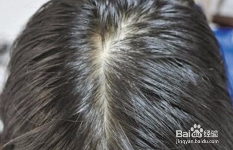 脂溢性脱发脂溢性皮炎防治要点
