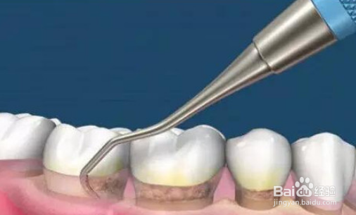 种牙后需要怎么护理