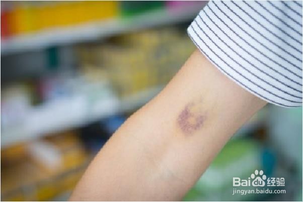 用自然疗法减轻血肿