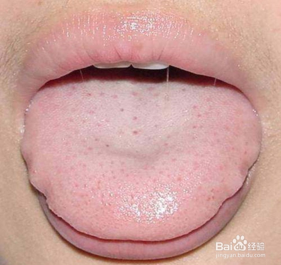 如何判断自己有没有湿气