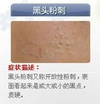 痘痘的种类有哪些