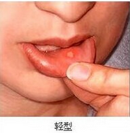 处理口腔溃疡的小方法
