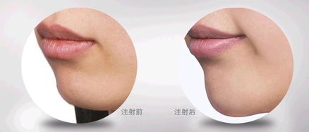 垫下巴最好的方法