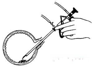 怎么预防膀胱癌复发