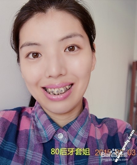 牙齿矫正：[2]带牙套的第二天的感受