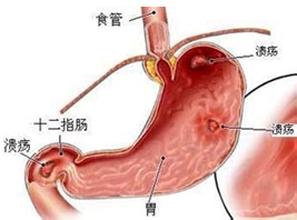 三种胃病 怎么吃最健康?