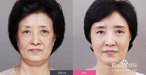 女性眼睛下垂做提眉手术性价比最高